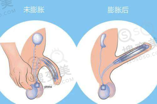 西安爱尔眼科医院之手术方式