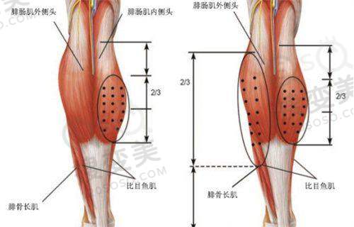 电波拉皮多少钱一次之不同地区价格区别
