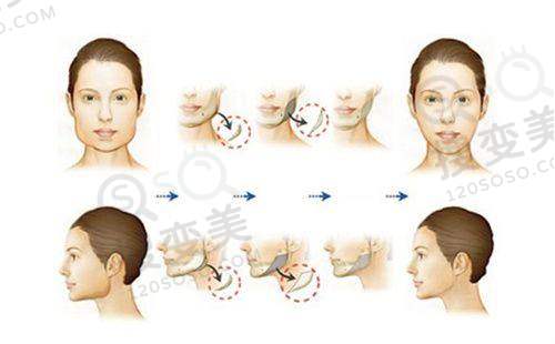 宝宝龋齿发展阶段蛀牙图片展示