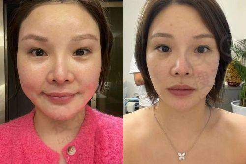 汕头汕美医疗美容医院怎么样？资质优医生强，双眼皮手术效果获好评！ 