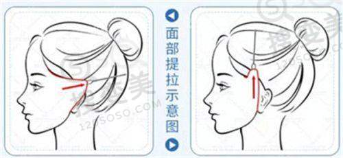 亚韩医疗美容医院郑京湘医生双眼皮技术