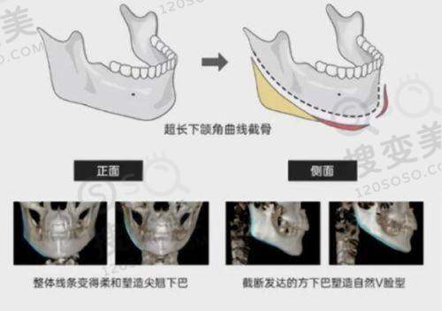 苏州牙博士口腔医院种植牙价格优势