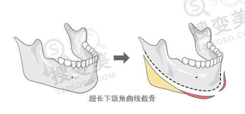脸打了轻薄针后的图片:结合其他项目成效更佳