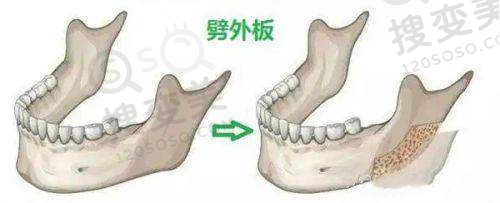 平湖钟埭杭成口腔补牙技术与蛀牙图片关联