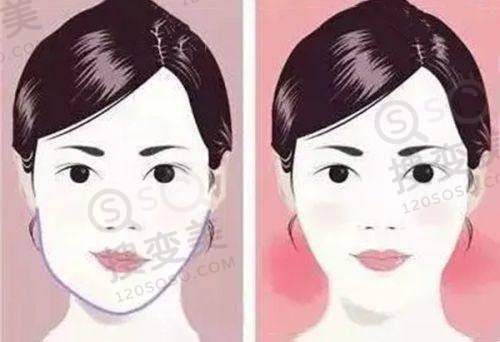 正雅隐形牙套的价格因素