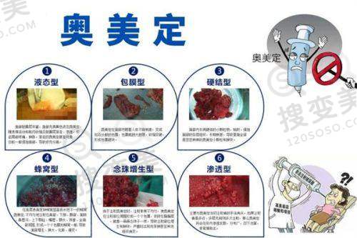 曼托假体价格与其他品牌的对比