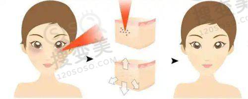 套筒冠义齿值得选吗?美冠塔医生技术优,全口价省一半口碑好