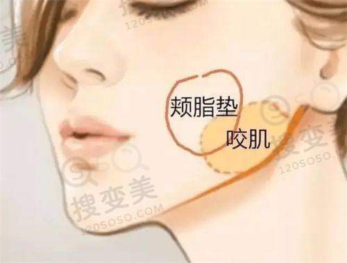 多地医院曼托假体的价格情况