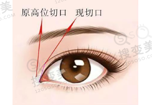 宋新医生技术优势