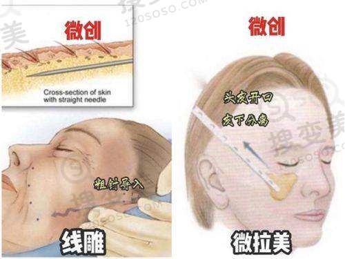 手术原理