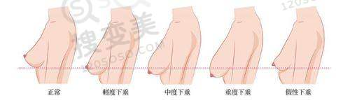双眼皮南京哪家整形院比较好之南京美贝尔整形医院