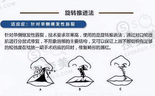 贵阳双眼皮做得好的医生之李邦珍