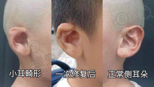 脂肪填充老了会怎样：年龄与全脸脂肪填充的关系