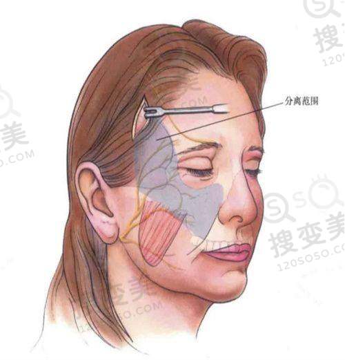 我的脂肪填充维持了5年：山根填充的成效展现