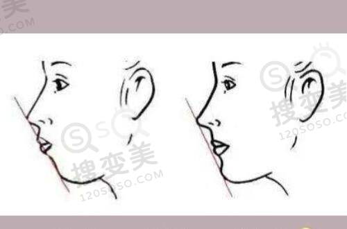 南宁整形医院脂肪填充费用之选择建议