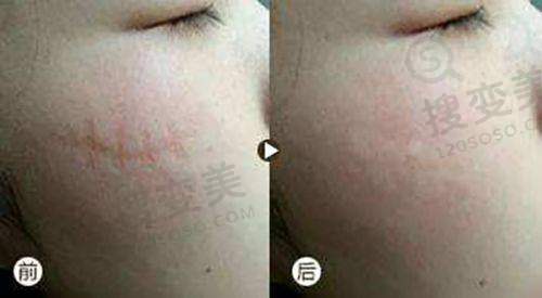 南宁脂肪填充好的医院有哪些？南宁华美及医生技术、价格、案例揭秘