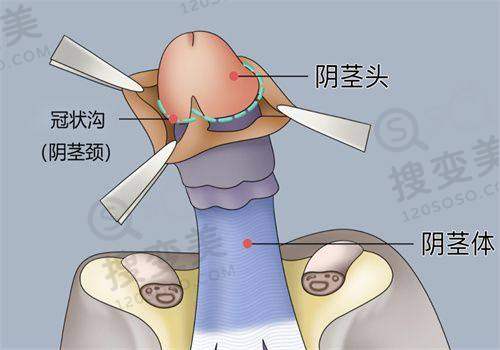 男性隆胸800cc的综合评估与建议