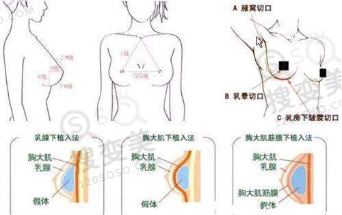 长沙丰胸更好的医院排名之医生技术对比