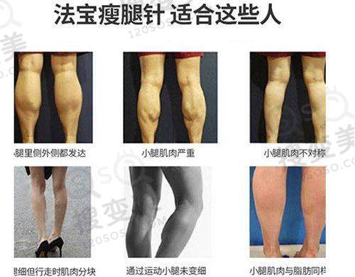 南京比较好的双眼皮修复医生之汪树杰