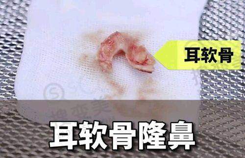 贵阳双眼皮哪家医院比较好一点——贵阳利美康整形医院