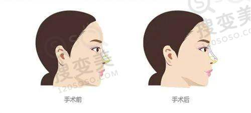 贵阳隆鼻哪家医院好之医生推荐及价格参考