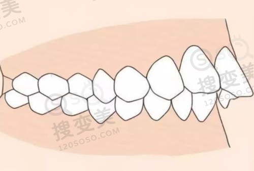 南京牙齿美白价格大概多少左右？多医院价格参考及效果感受揭秘 