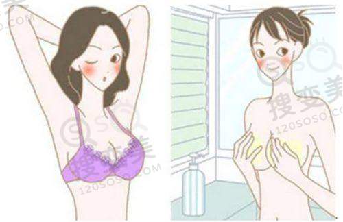 男隆胸6个月变化图片：术后6个月蜕变