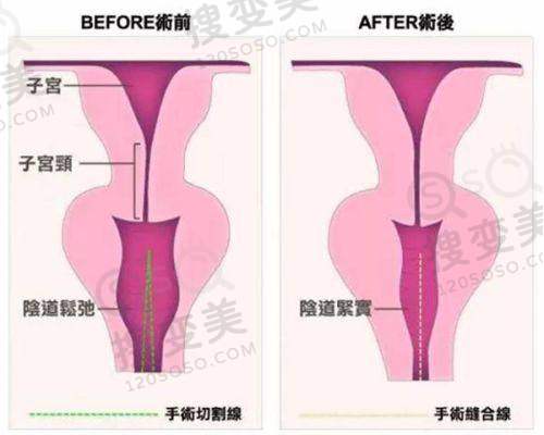 南宁整形医院脂肪填充费用之影响因素