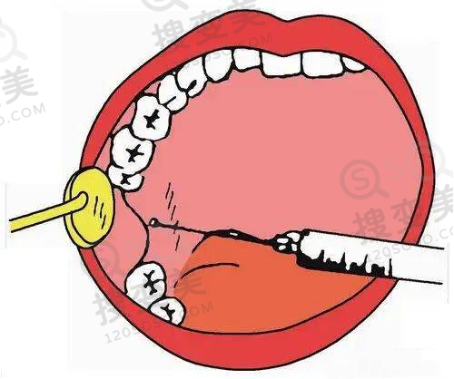 合肥做双眼皮埋线哪家好?合肥竹一整形