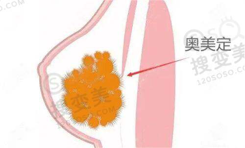 男隆胸6个月变化图片：术前准备阶段