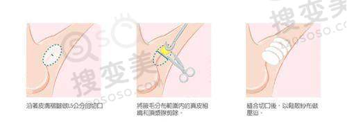 南宁脂肪填充好的医院之南宁华美脂肪填充实例