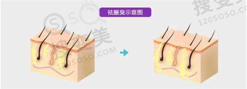 贵阳做双眼皮更好的医生之周涛医生其他擅长领域