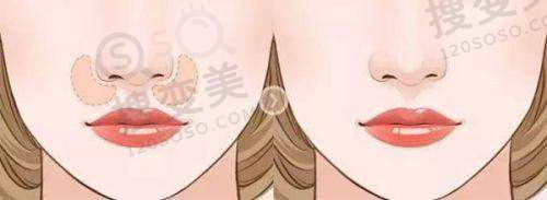 贵阳割双眼皮哪个医院最好？省医/贵医附院/利美康技术优口碑好 