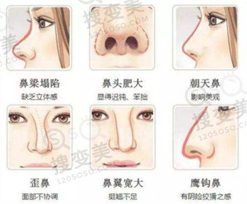 双眼皮南京哪家整形院比较好之南京美伊成医疗美容