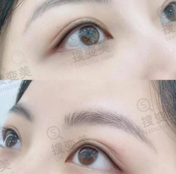 南京做双眼皮更好的医生排名之陈小剑医生