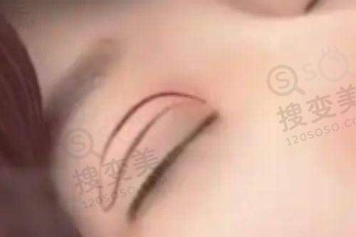 2025农村老人白内障免费申请流程大更新！三证齐全7天拿补助，错过再等一年——申请材料清单