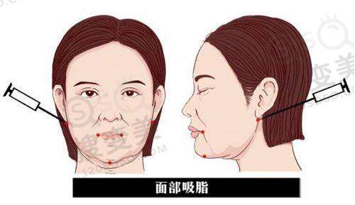 成都整形在线询问24小时：成都罗恩医生