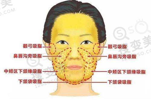 成都小拉皮哪个医院好？成都懿和唯美蒲兴旺技术优、恢复快、口碑好