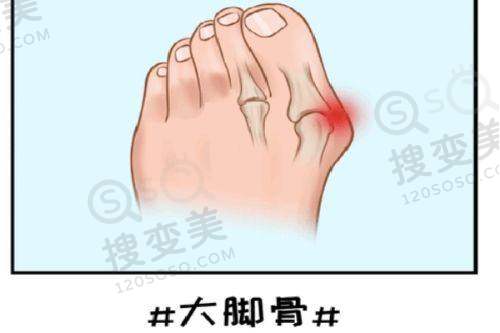 btl360胶原枪不止适合眼周细纹，修复期较短