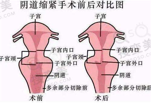 btl360胶原枪不止适合眼周细纹，使用注意事项