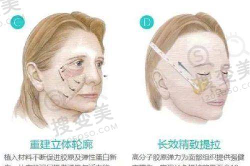 腋臭做手术可以完全有效治疗吗——传统手术与复发情况