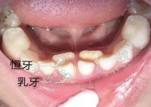 常德等地指定医院70岁以上老人免费种牙政策详情