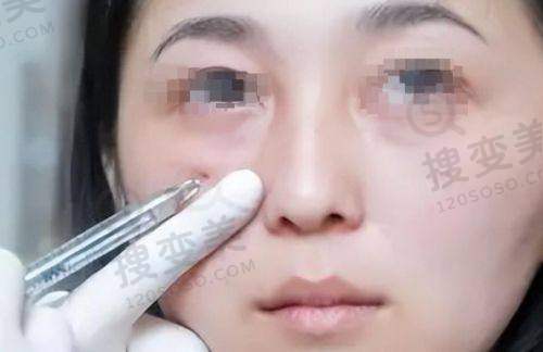 薇琳医美自体脂肪隆胸的特色及热线询问重点