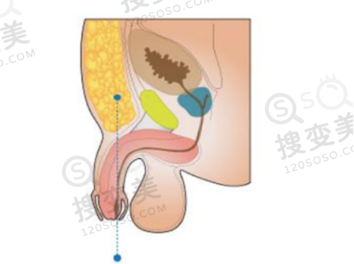腋臭手术后会复发吗?洛阳三家整形医院手术复发情况