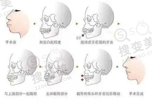 泰国去势手术费用多少钱？咖蒙/曼谷雨/然禧等医院收费40W泰铢起可咨询