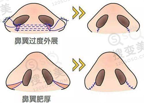广州：0元毛囊检测助力精细植发+红黑榜分析