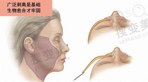 2025上海腰腹双c腰抽脂医院排名前十之技术优势分析