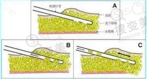 不同技术腋臭的手术一般多少钱