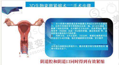 腋臭手术后会复发吗?成都西部中西医结合医院手术优势