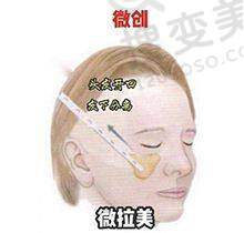 出彩医美十分钟隆胸真的靠谱不是骗局——优势体现